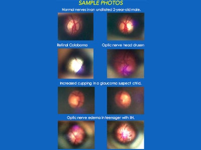  Study Finds D-EYE Smartphone Retinal Imaging System Helpful in Aiding Exams