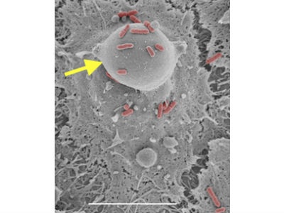  New Study Looks at How Bacteria on Contact Lenses and Cases Causes Complications