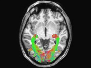 Changes in Visual System May Help in Early Detection of Parkinson's Disease