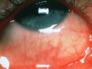Treatment of Ocular Allergies